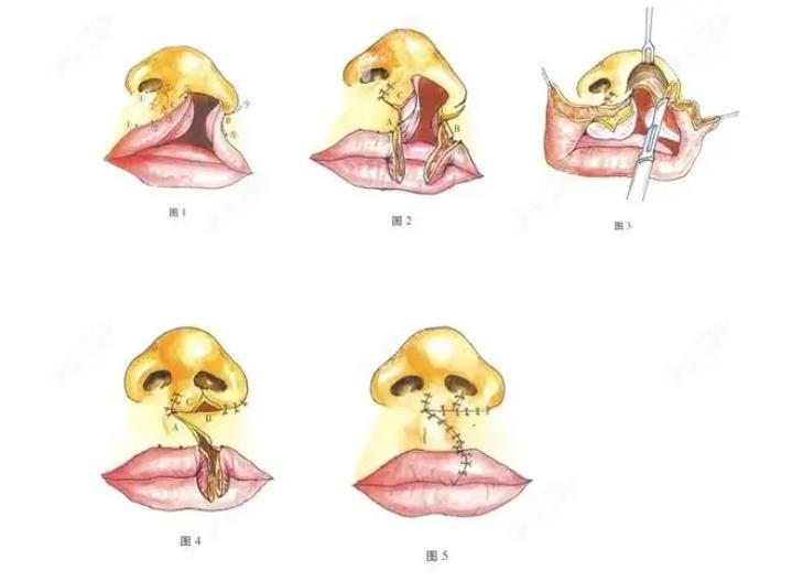 北京马群医生唇腭裂修复技术图