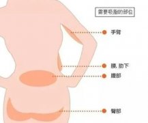 吸脂减肥怎么样?吸脂减肥的优缺点有哪些呢?