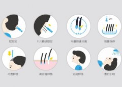蛋白纤维植发好不好？他又有什么不足的地方呢？