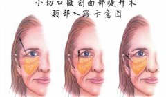 微创脸部提升能维持多久？手术原理+注意事项，延缓衰老有妙招