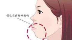 戽斗脸是什么脸型？可以通过这个方法进行改善！拯救大脸危机