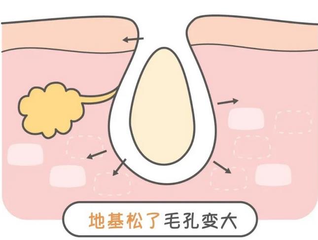 十滴水和甲硝唑凝胶能缩小毛孔吗