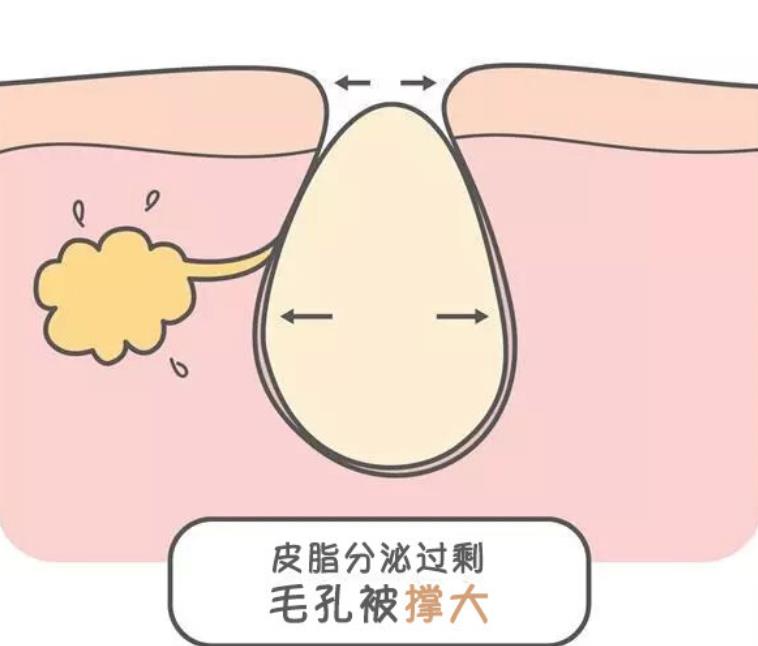 十滴水和甲硝唑凝胶能缩小毛孔吗