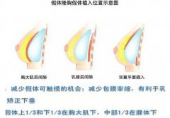 双平面丰胸优势有哪些？手术原理分析_注意事项盘点