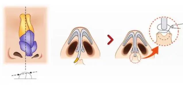 歪鼻矫正是什么原理