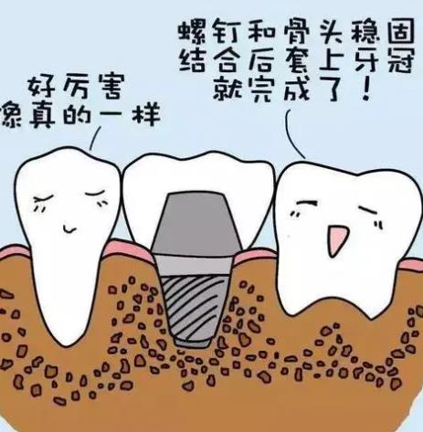 国内种植牙技术成熟吗