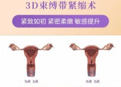 3d生物束带紧缩术能维持几年？手术原理揭晓，让你紧致如初