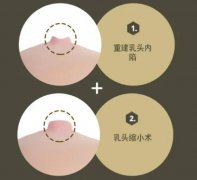 支架法乳头内陷矫正术原理公开！科学矫正，用心呵护