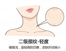 嗨体去颈纹利弊揭晓，想即刻甩掉老态选它