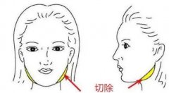 下颌角整形安全吗？解读手术原理，改善“国字脸”