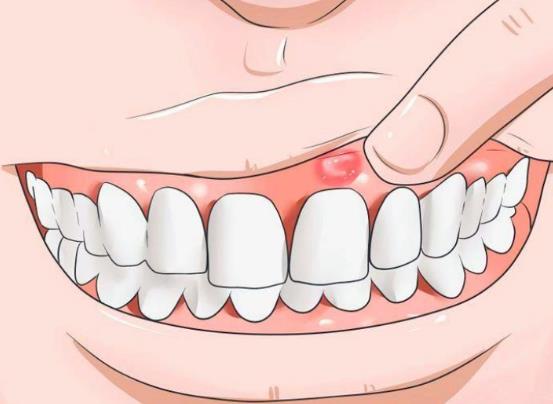 牙龈肿痛如何快速消肿止痛
